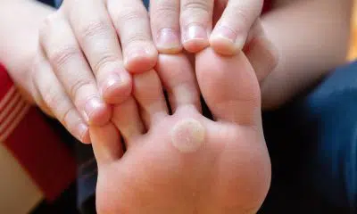 foot with problem areas on the skin, dry corn. plantar wart of the foot. unhealthy foot skin concept. cosmetology and skin care concept